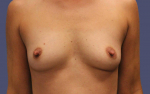 Breast Augmentation 8 Before